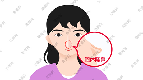 美恩软骨隆鼻的优势是什么