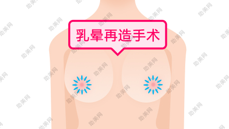 乳晕再造手术的特点是什么呢？