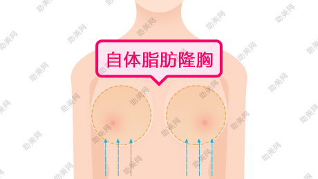 武汉陈继忠自体脂肪隆胸多少钱