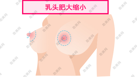 乳头胸部整形