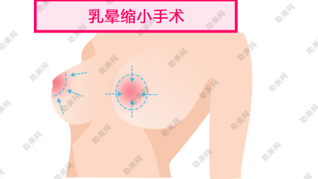 燕岭乳晕缩小后能接触水吗