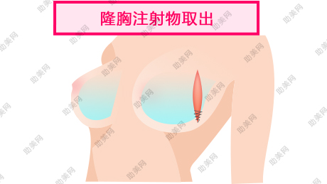 奥美定取出手术需要多少钱