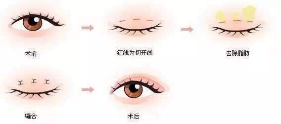 微创双眼皮