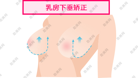 什么是乳房下垂矫正手术呢