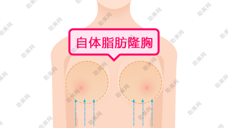 注射丰胸手术会有副作用吗？