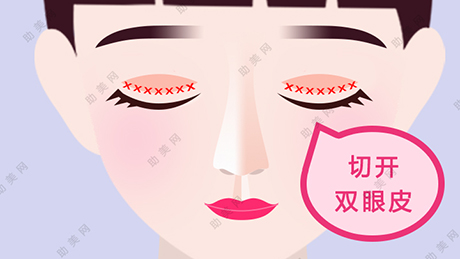 切开法双眼皮手术有什么好处