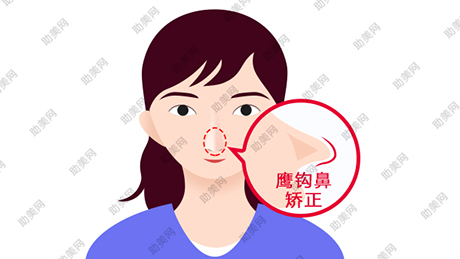 鹰勾鼻矫正的安全性很高吗