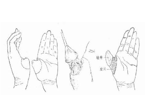拇指再造术后有哪些并发症？